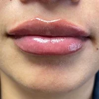 PDO threads jawline – after