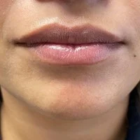 PDO threads jawline – before