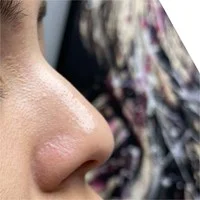 SkinPen acne scarring – before