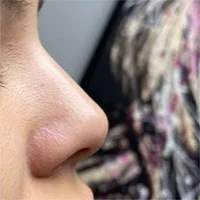 SkinPen acne scarring – after