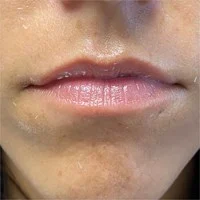 KYBELLA submental – before