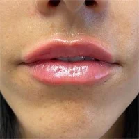 KYBELLA submental – after
