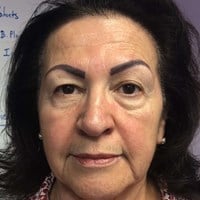 Wrinkle relaxers forehead – before