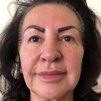 Wrinkle relaxers forehead – after
