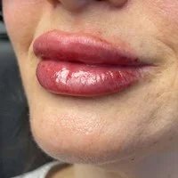 RHA fillers cheeks – after