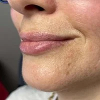 RHA fillers cheeks – before